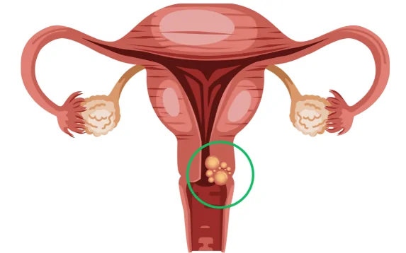 vulva kanseri